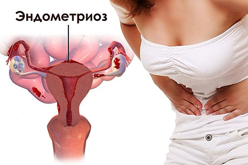 Эндометриоз шейки матки фото